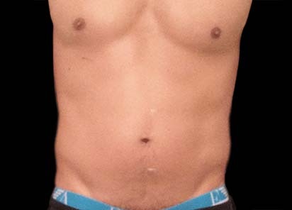 emsculpt