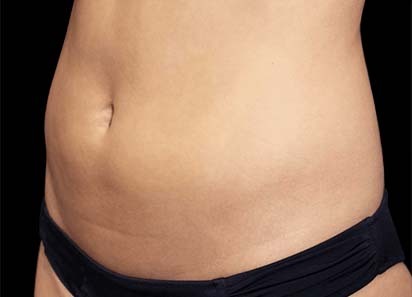 emsculpt