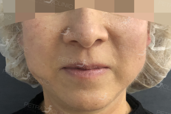 Skin tightening in the cheek area