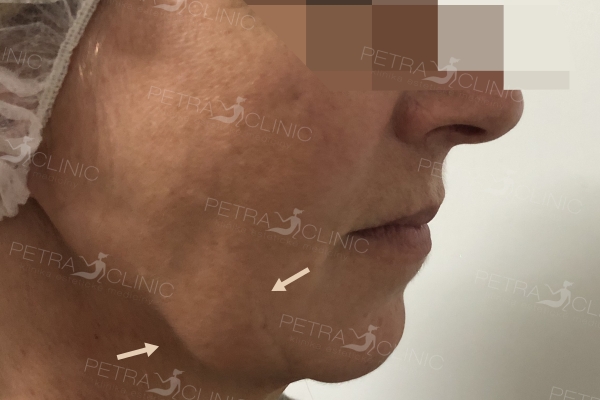 Skin tightening using threads