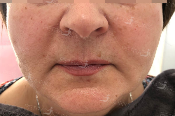 Facial revitalization with liquid lift