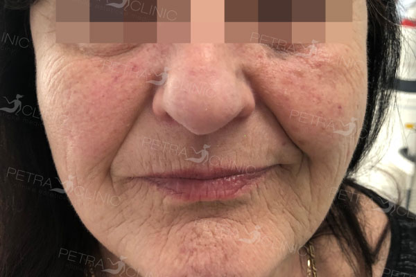 Skin tightening with thread lift