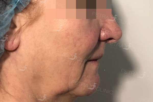 Lifting of contours in the cheek area