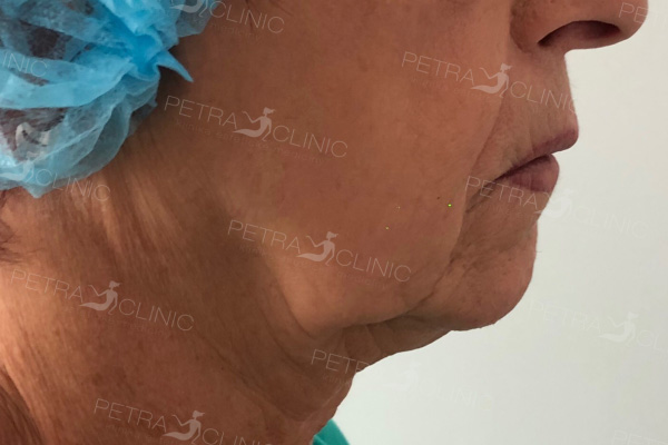Skin tightening