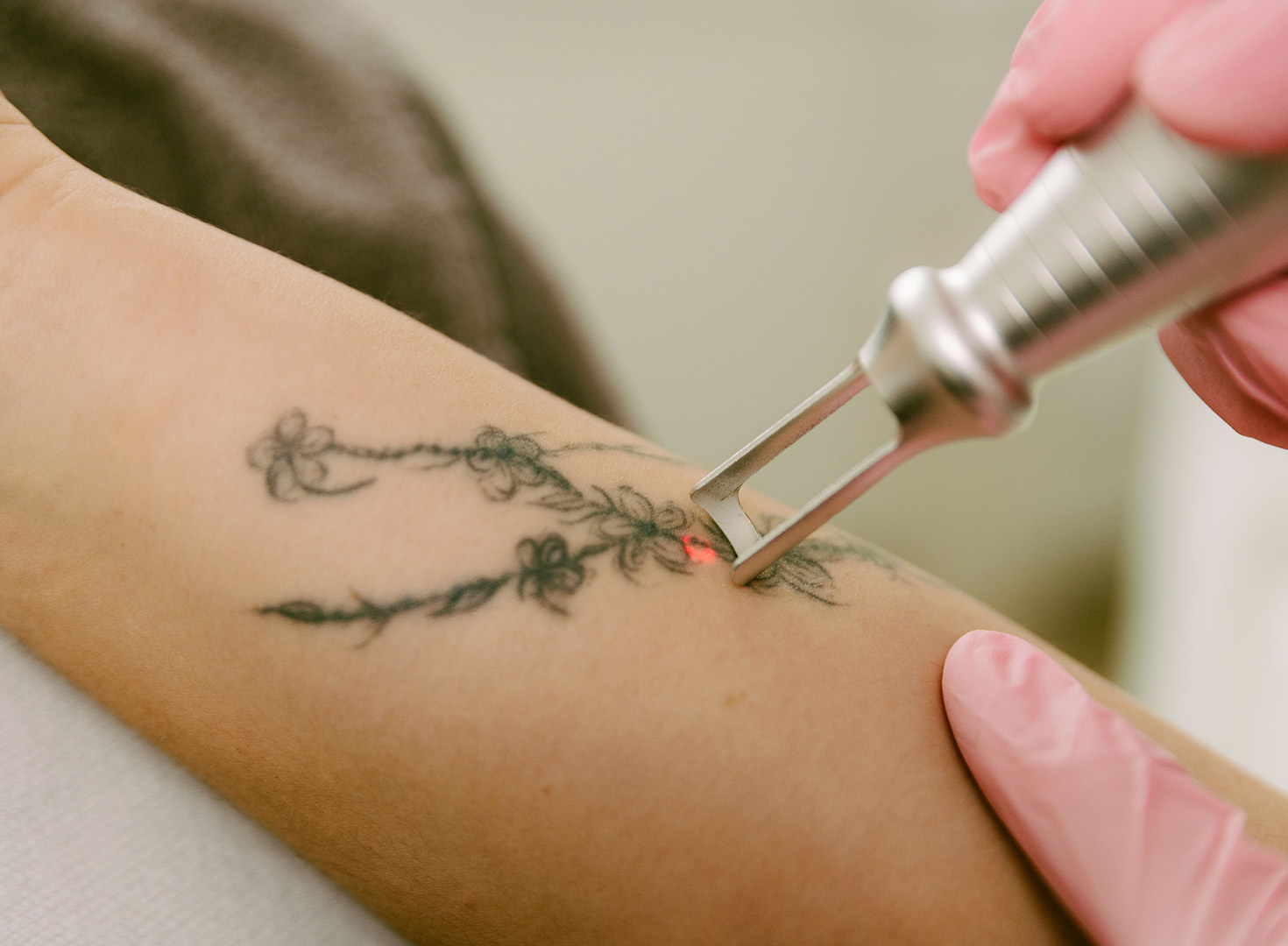 Tattoo removal